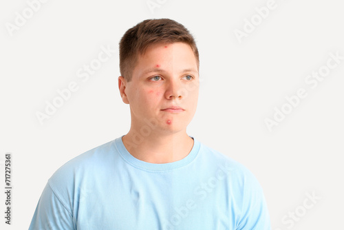 Comparison portrait of teenage boy before and after acne treatment on white background