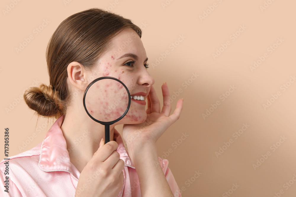Young woman with acne problem and magnifier on beige background, closeup Young woman with acne problem and magnifier on beige background, closeup