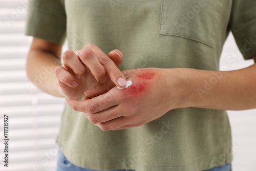 Woman applying healing cream onto burned hand indoors, closeup photo