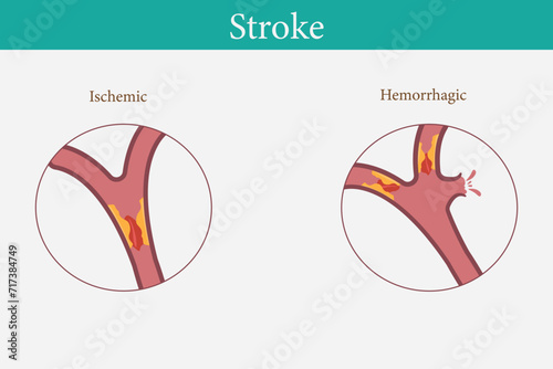 Human anatomy disease Ischemic stroke vector with hemorrhagic stroke illustration on white background. eps 10 photo