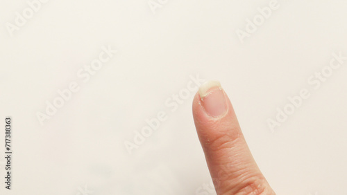 爪が割れて痛んだ人差し指 photo