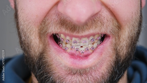 Adult Caucasian Male with Serious Malocclusion of Chipped and Damaged Teeth with Metal Dental Braces For Orthodontic Treatment photo