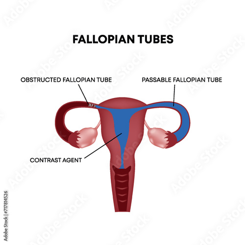 Checking the patency of the fallopian tubes. Female reproductive system. Vector illustration