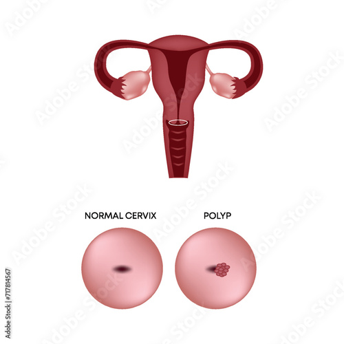 Uterus and cervix healthy and cervix with polyp. Female reproductive system. Vector illustration