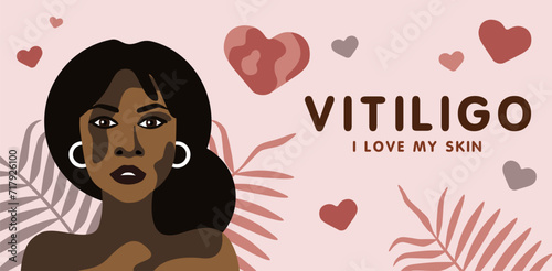 Banner about vitilingo skin disease with young beautiful woman, minimalistic vector