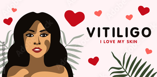 Banner about skin disease vitilingo with young beautiful woman with European appearance minimalistic