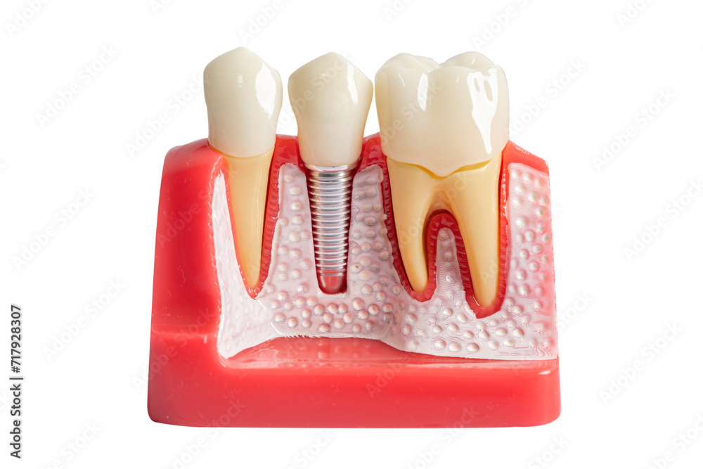 Dental implant, artificial tooth roots into jaw, root canal of dental