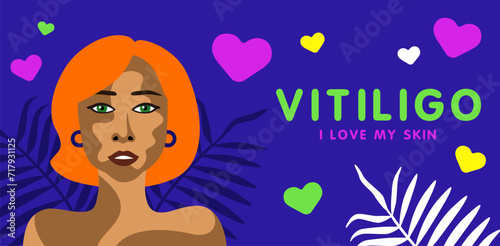 Banner about vitilingo skin disease with young beautiful redhead woman minimalistic vector