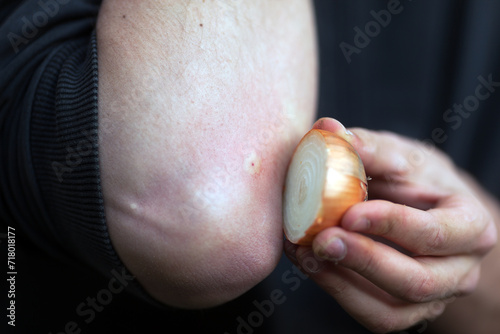 Natural Alternative Remedial for Bee Puncture is To Apply a Cut Onion on the Puncture to Absorb the Bee Venom photo