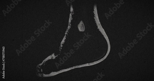 MRI scan of a male foot scanning from side to side, exhibiting multiple small fractures spread throughout the entire foot after riding a motorcycle over own foot photo