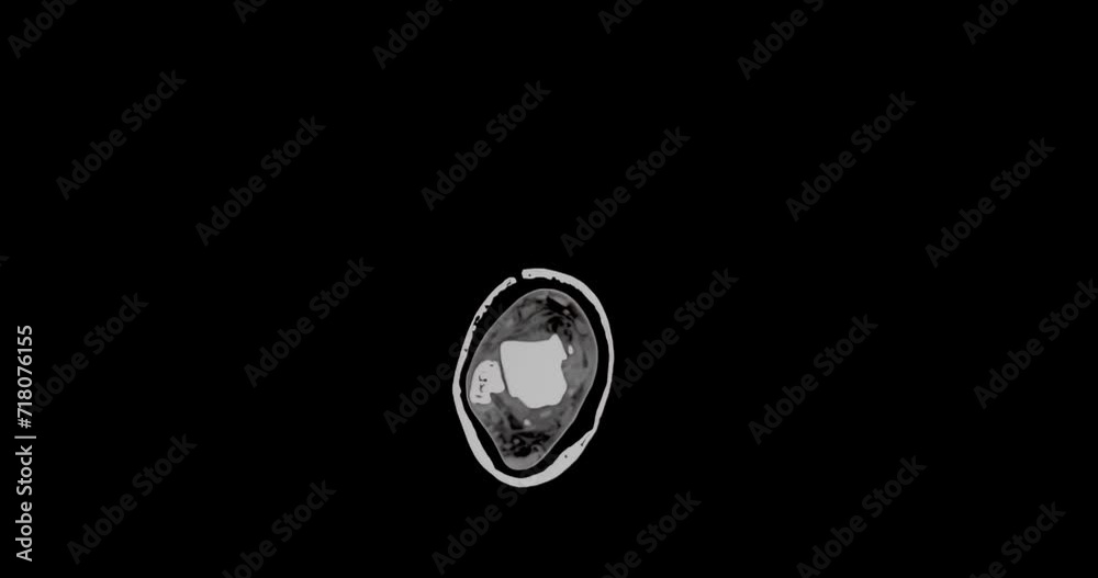 MRI scan of a foot showing multiple small fractures, slowly scanning from top to bottom and showing whole foot MRI scan of a foot showing multiple small fractures, slowly scanning from top to bottom and showing whole foot