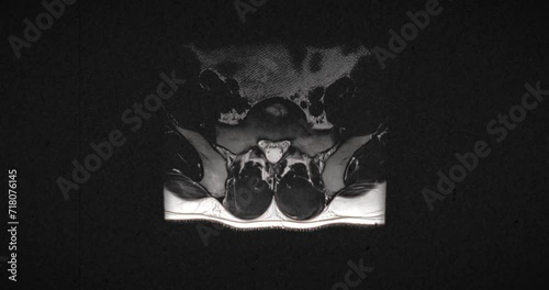 Grungy and highly textured vintage MRI scan of male lumbar spine with a herniated disc due to excess weightlifting training. Scanning from top to bottom photo