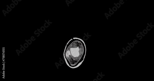 MRI scan of a foot showing multiple small fractures, slowly scanning from top to bottom and showing whole foot photo