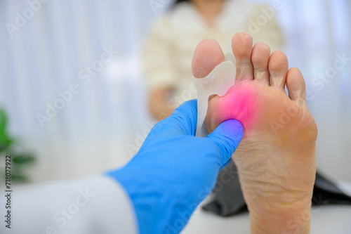 A doctor orthopedist examining leg with Hallux Valgus deformity on the first toe. Foot treatment with the orthopedic unit treats pain caused by uncomfortable shoes photo