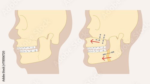 Corrective Jaw Surgery
