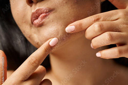 close up photo of cropped young woman with acne prone skin popping pimple on face, skin issues