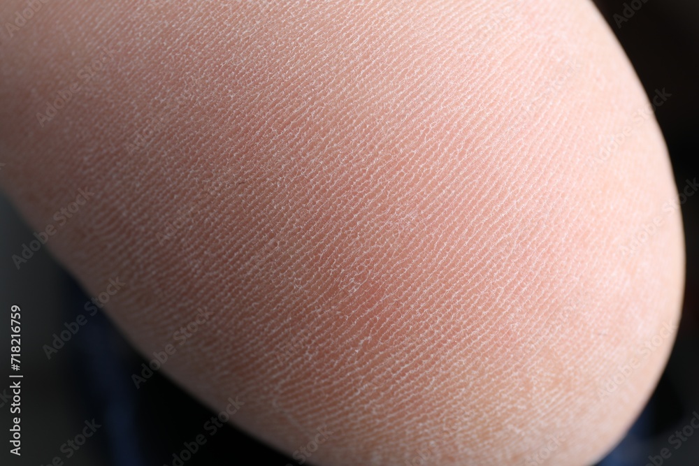 Fototapeta premium Woman with dry skin on foot, closeup