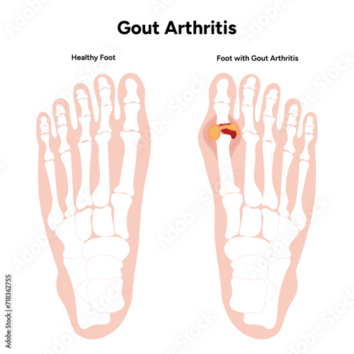 Medical illustration gout arthritis foot and health foot