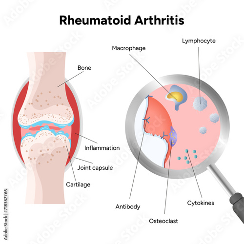 Medical infographic rheumatoid arthritis   photo