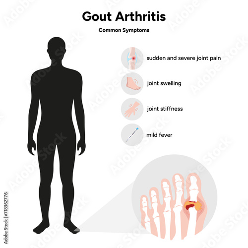 Medical information gout arthritis common symptoms  