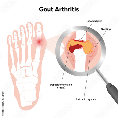 Medical infographic gout arthritis in the foot 