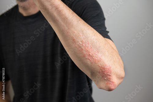 	
Acute psoriasis on elbows, knee is an autoimmune incurable dermatological skin disease. Large red, inflamed, flaky rash on the knees. Joints affected by psoriatic arthritis	
