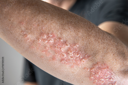 
Psoriasis, a skin disease photo
