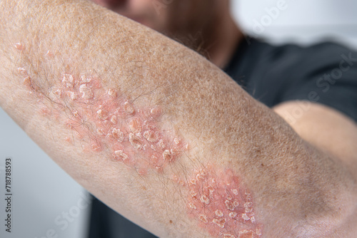 
Psoriasis, a skin disease photo