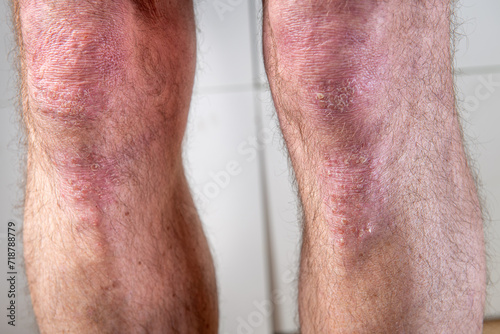 Psoriasis, a skin disease