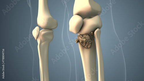 Cancer spreading along a leg bone