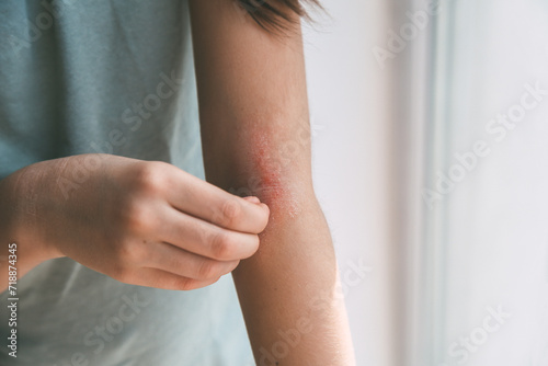 Cuadro en lienzo a girl scratches the skin on the elbow of her arm, redness is atopic dermatitis,