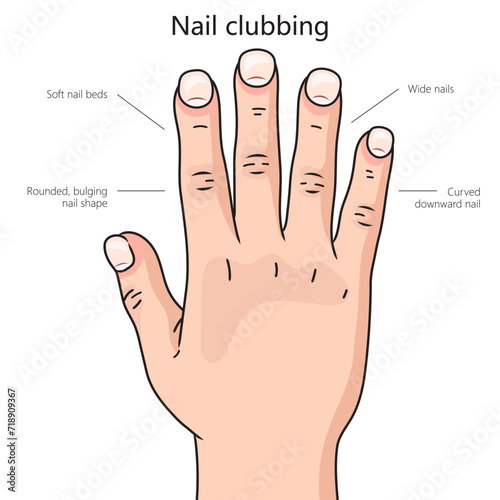 Nail clubbing diagram hand drawn schematic vector illustration. Medical science educational illustration