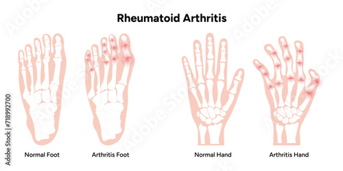 Medical illustration of rheumatoid arthritis and normal hands and feet