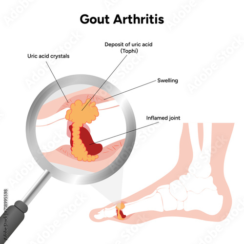 Medical infographic the gout arthritis 