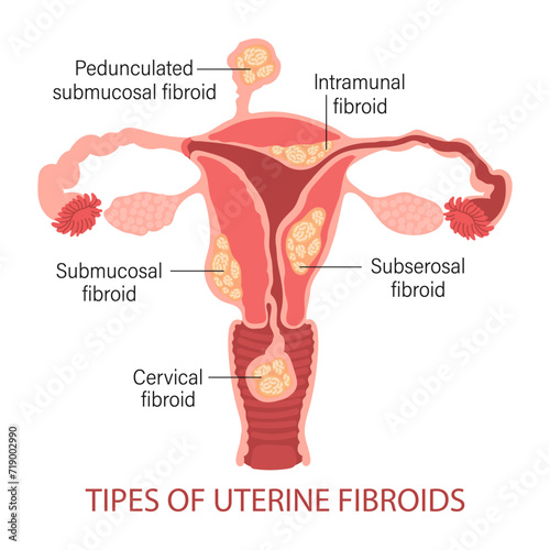 Diagram of types of uterine fibroids in a woman on a white background. Genicolgia. Medical concept. Infographic banner. Vector