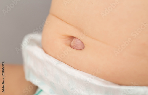 Umbilical hernia in a newborn baby on the stomach. Treatment of umbilical hernias in children without surgery, medical. Close-up