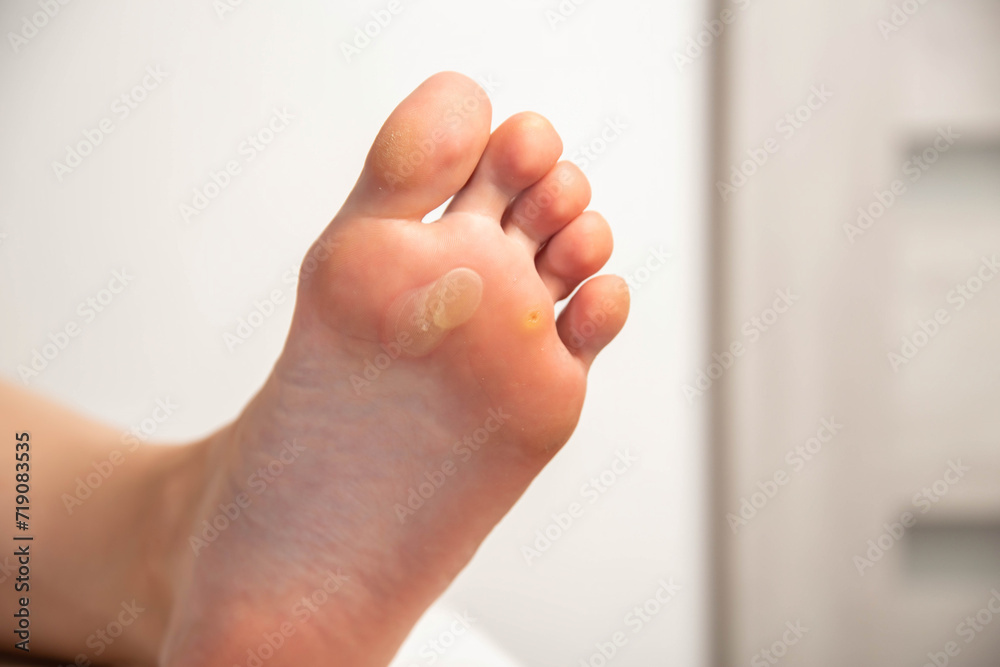 Naklejka premium Human foot with a large callus and chicken jowl wart on a white background, close-up. Human papilloma virus