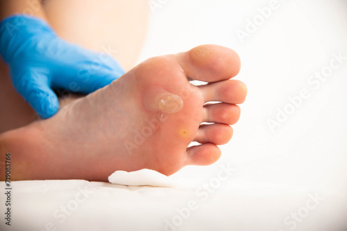 A doctor examines the foot of a person who has a large callus and a stem wart. Treatment and removal of warts and corns, close-up photo