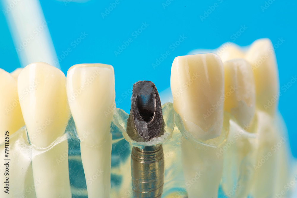 Dental pin in a medical model of the patient's jaw for putting on a