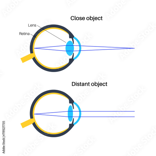 Eye accommodation poster