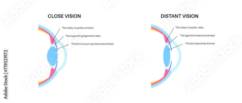 Eye accommodation poster