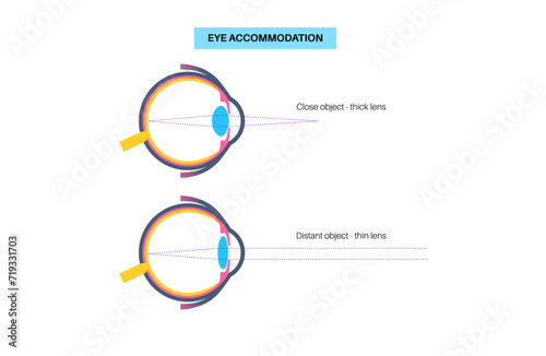 Eye accommodation poster