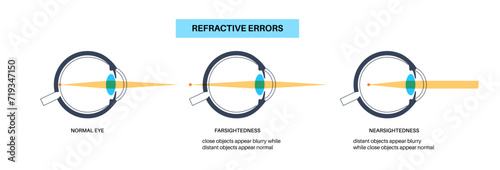 Farsightedness and nearsightedness