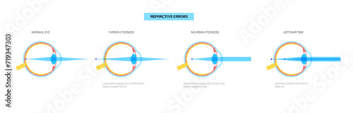 Refractive errors poster
