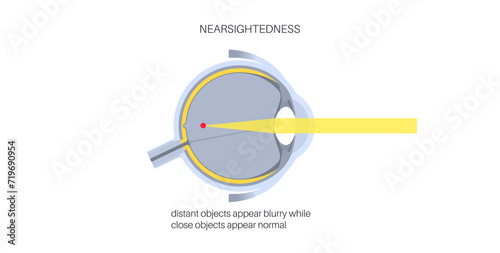 Nearsightedness eye disease