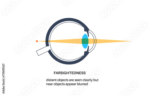 Farsightedness eye disease