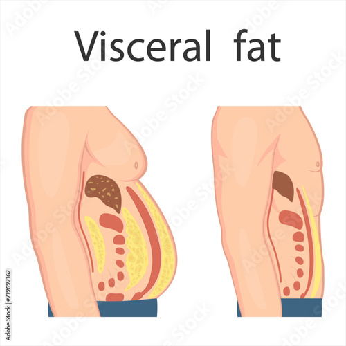 Medical poster about visceral fat. Abdominal fat surrounds the inner doors of the abdominal cavity. Overweight disease concept. Weight loss, liposuction, and diet.