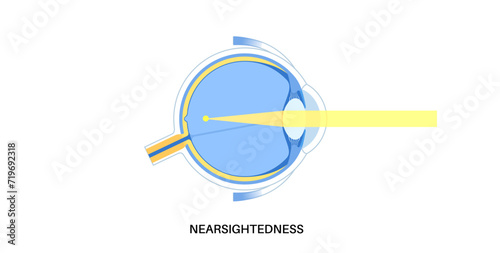 Nearsightedness eye disease