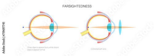 Normal eye and farsightedness photo