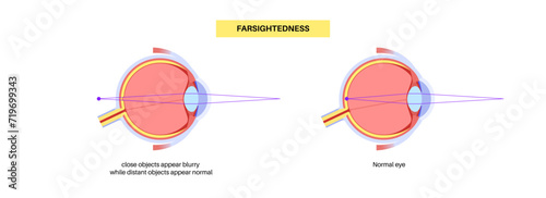 Normal eye and farsightedness